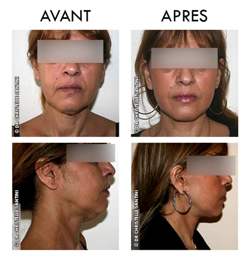 A Face And Neck Lift Dr Santini